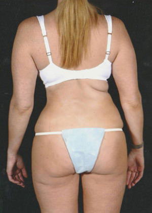 Liposuction Before & After Patient #8594