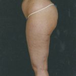 Liposuction Before & After Patient #8594