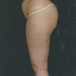 Liposuction Before & After Patient #8594