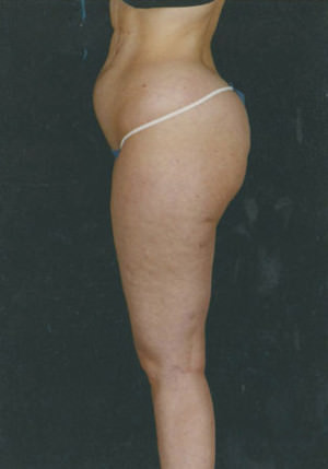 Liposuction Before & After Patient #8594