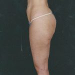 Liposuction Before & After Patient #8594