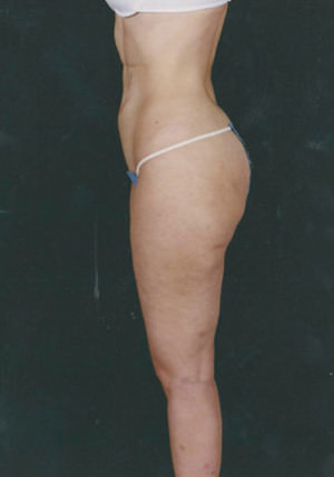 Liposuction Before & After Patient #8594