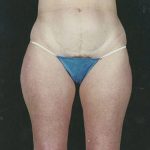 Liposuction Before & After Patient #8599