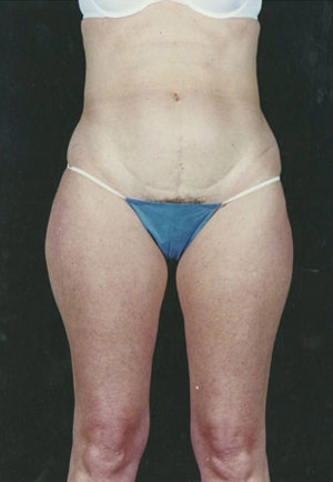 Liposuction Before & After Patient #8599