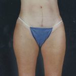 Liposuction Before & After Patient #8599