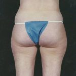 Liposuction Before & After Patient #8599