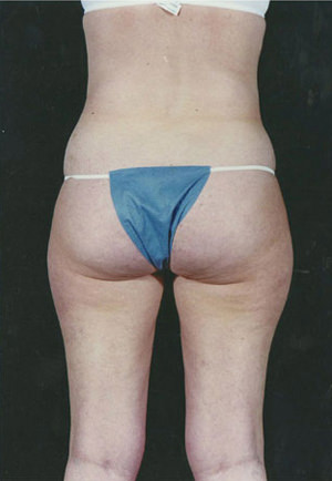 Liposuction Before & After Patient #8599