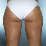 Liposuction Before & After Patient #8604