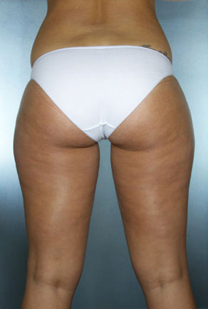 Liposuction Before & After Patient #8604
