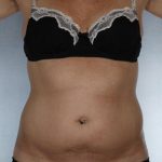 Liposuction Before & After Patient #8609
