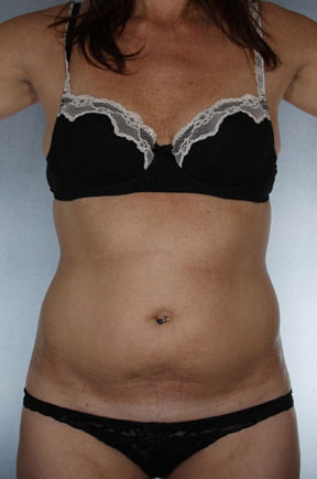 Liposuction Before & After Patient #8609