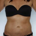 Liposuction Before & After Patient #8609