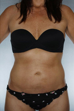 Liposuction Before & After Patient #8609