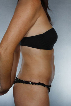 Liposuction Before & After Patient #8609