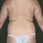 Liposuction Before & After Patient #8614