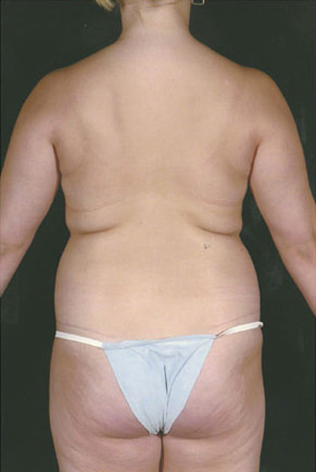 Liposuction Before & After Patient #8614