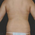 Liposuction Before & After Patient #8614
