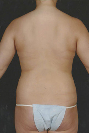 Liposuction Before & After Patient #8614