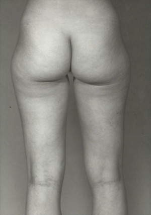 Liposuction Before & After Patient #8622