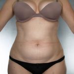 Liposuction Before & After Patient #8635