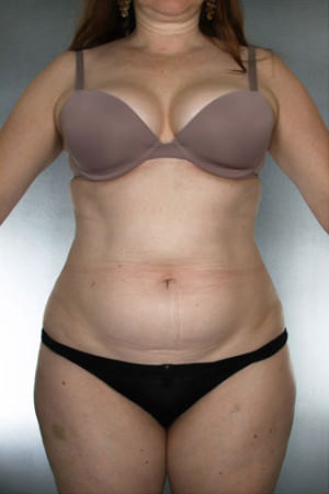 Liposuction Before & After Patient #8635