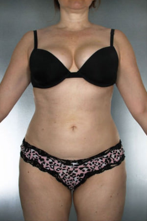 Liposuction Before & After Patient #8635