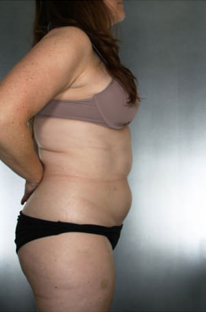 Liposuction Before & After Patient #8635