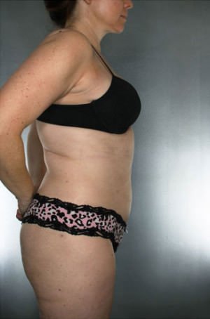 Liposuction Before & After Patient #8635