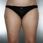 Liposuction Before & After Patient #8635