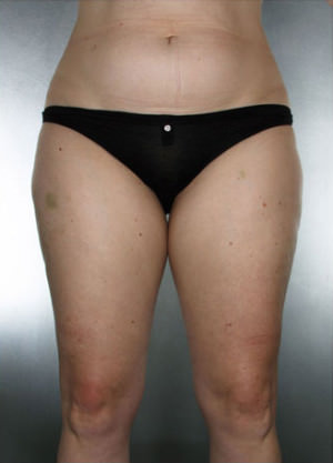 Liposuction Before & After Patient #8635