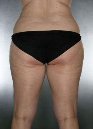 Liposuction Before & After Patient #8635