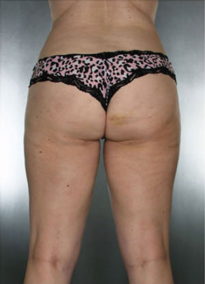 Liposuction Before & After Patient #8635