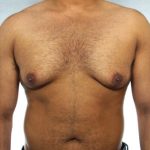 Gynecomastia Before & After Patient #8411