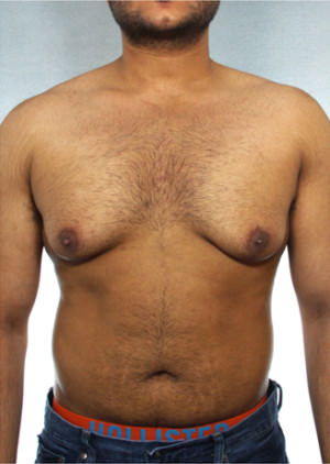 Gynecomastia Before & After Patient #8411