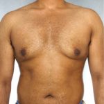 Gynecomastia Before & After Patient #8411