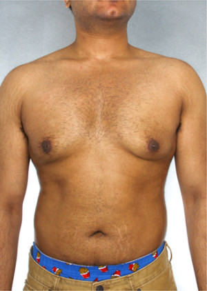 Gynecomastia Before & After Patient #8411