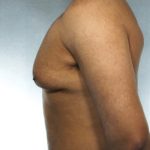 Gynecomastia Before & After Patient #8411