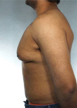 Gynecomastia Before & After Patient #8411