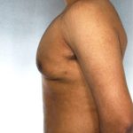 Gynecomastia Before & After Patient #8411
