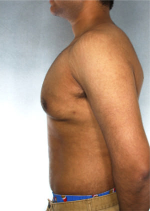 Gynecomastia Before & After Patient #8411