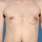 Gynecomastia Before & After Patient #8416