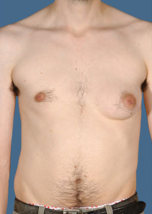 Gynecomastia Before & After Patient #8416