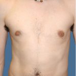Gynecomastia Before & After Patient #8416