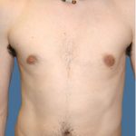 Gynecomastia Before & After Patient #8416