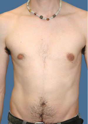 Gynecomastia Before & After Patient #8416