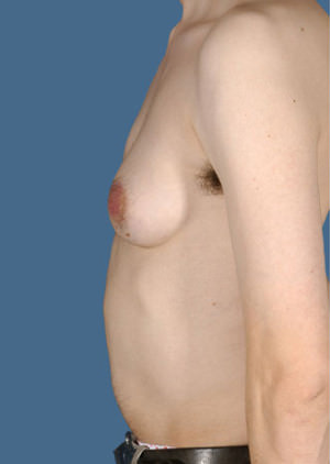 Gynecomastia Before & After Patient #8416