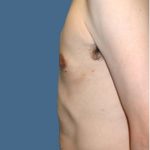 Gynecomastia Before & After Patient #8416