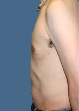 Gynecomastia Before & After Patient #8416