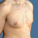 Gynecomastia Before & After Patient #8421