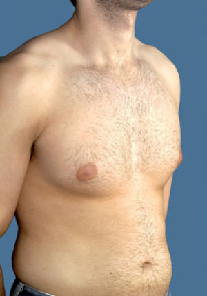 Gynecomastia Before & After Patient #8421